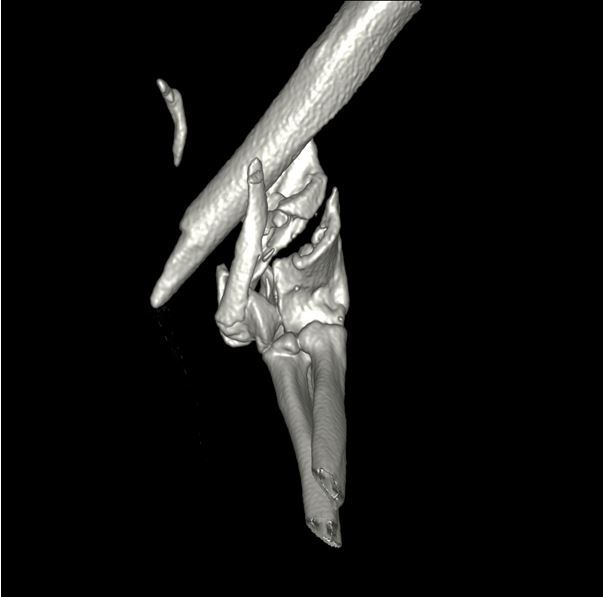 3D CT reconstruction of the left elbow prior to surgery